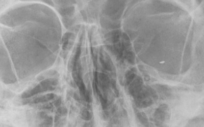 Eye injuries and DIY during lockdown