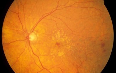 I have a macular problem – how worried should I be about delay in treatment?